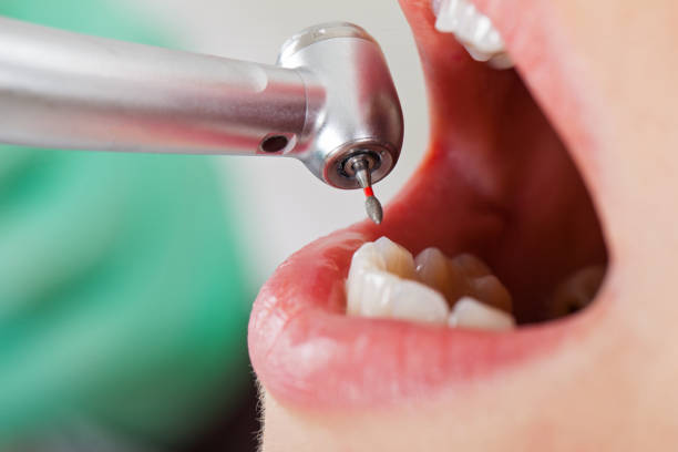 Best Emergency Dentist for Lost Fillings or Crowns in Wakarusa, IN